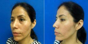 Case Restylane And Fillers Patient By Doctor Marwan R. Khalifeh, MD, Chevy Chase Plastic Surgeon