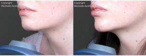 Chin Enhancement Before & After By Dr Alexander Rivkin, MD, Los Angeles Physician