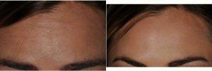 Conservative Botox For Forehead Wrinkles By Doctor Joseph B. Silberman, DMD, FAGD, Evanston Dentist