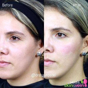 Correcting Undereye Hollowing And Dark Circles With Fillers By Dr. Shaun Patel, MD, Coral Gables FL Physician