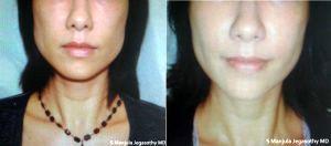 Creating A Heart-Shaped Face With Botox By Dr Manjula Jegasothy, MD, Miami Dermatologist