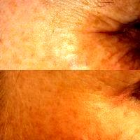 Crows Feet And Botox Images
