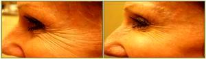 Crows Feet Botox Treatment By Dr. Tricia Brown, Dermatologist In Houston, TX