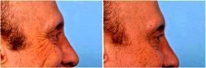 Crows Feet Botox by Dr. Steven H. Dayan, MD, Doctor in Chicago, Illinois
