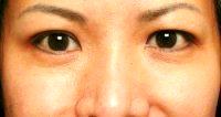 Crows Feet By Dr Mehryar (Ray) Taban, MD, FACS, Beverly Hills Oculoplastic Surgeon