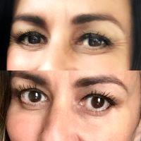 Crows Feet Treatment Botox Injections Results