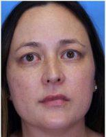 Dark Spots And Wrinkles Treated With Botox With Dr. Ava Shamban, MD, Santa Monica Dermatologic Surgeon