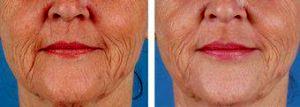 Dermal Filler To Wrinkles By Dr. Jeffrey Kenkel, MD, Dallas Plastic Surgeon