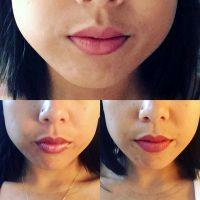 Dermatologists Can Also Inject Tiny Drops Of Botox Along The Upper Lip Border