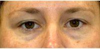 Doctor Alex Eshaghian, MD, PhD, Encino Physician - 32 Year Old Woman Treated With Restylane