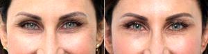 Doctor Amy K. Hsu, MD, Beverly Hills Facial Plastic Surgeon - Botox And Restylane To Crow's Feet