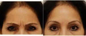Doctor Anand G. Shah, MD, San Antonio Facial Plastic Surgeon - 29 Year Old Woman Treated With Botox