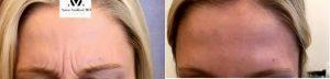 Doctor Anna Avaliani, MD, New York Physician - 42 Year Old Woman Treated With Botox