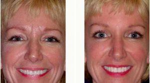 Doctor Anna Petropoulos, MD, FRCS, Boston Facial Plastic Surgeon - Botox