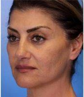 Doctor Ava Shamban, MD, Santa Monica Dermatologic Surgeon - Fine Lines And Wrinkles Treated With Botox