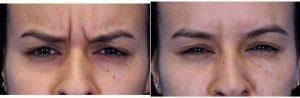 Doctor Ava Shamban, MD, Santa Monica Dermatologic Surgeon - Treatment Of Forehead Wrinkles With Botox