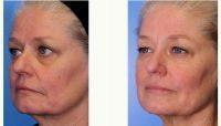 Doctor Ava Shamban, MD, Santa Monica Dermatologic Surgeon - Under Eye And Cheek Wrinkles Treated With Botox