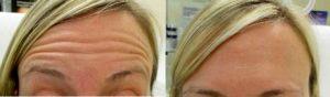 Doctor Benjamin Barankin, MD, FRCPC, Toronto Dermatologic Surgeon - 37 Year Old Woman Treated With Botox For Forehead Wrinkles