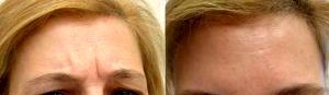 Doctor Benjamin Barankin, MD, FRCPC, Toronto Dermatologic Surgeon - 40 Year-old Female Treated With Botox Injections For Frown Lines