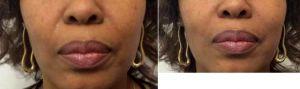 Doctor Benjamin Caughlin, MD, Chicago Facial Plastic Surgeon - 61 Year Old Woman Treated With Restylane