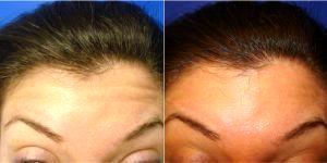 Doctor Benjamin J. Cousins, MD, Miami Beach Plastic Surgeon - 29 Year Old Female Treated With Botox The Forehead