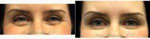 Doctor Brian Arslanian, MD, Atlanta Plastic Surgeon - 35 Year Old Woman Treated With Botox For Facial Rejuvenation Of The Eyes
