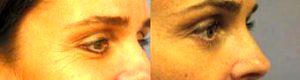 Doctor Brian M. Kinney, MD, FACS, Los Angeles Plastic Surgeon - Botox Before And After