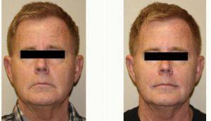 Doctor Bryan C. McIntosh, MD, Bellevue Plastic Surgeon - 58 Year Old Man Treated With Juvederm Vollure Before & After