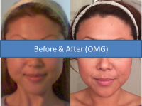 Doctor Catherine Weng, Denver Plastic Surgeon OnabotulinumtoxinA Before And After Photos Result