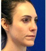 Doctor Cheryl Perlis, MD, FACOG, Highland Park Physician - 35 Year Old Woman Received Juvederm Cheek Augmentation To Improve Under Eye Hollows