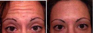 Doctor David Alessi, MD, Beverly Hills Facial Plastic Surgeon - Botox For Forehead Lines Injections