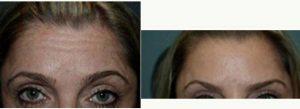 Doctor David Schlessinger, MD, Long Island Oculoplastic Surgeon - 48 Year Old Woman Treated With Botox And Restylane