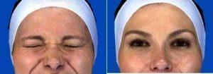 Doctor David Shafer, MD, FACS, New York Plastic Surgeon - Botox Crow's Feet Before And After