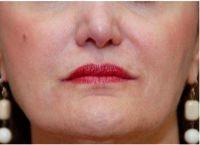 Doctor Dean P. Kane, MD, FACS, Baltimore Plastic Surgeon - 51 Year Old Woman Treated With Restylane