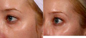 Doctor Elizabeth F. Rostan, MD, Charlotte Dermatologist - Restylane Under Eyes