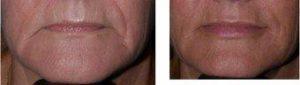 Doctor Emil A. Tanghetti, MD, Sacramento Dermatologist - Juvederm Lips And Marionettes