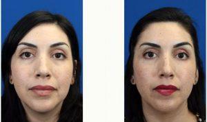 Doctor Eric J. Yavrouian, MD, Glendale Facial Plastic Surgeon - 30 Year Old Woman Treated With Restylane To Her Tear Trough