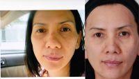 Doctor Farah Naz Khan, Dallas Plastic Surgeon Botox Injection Treatment Patient Image Result