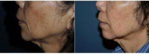 Doctor George Commons, MD, Palo Alto Plastic Surgeon - 70 Year Old Woman Treated With Juvederm