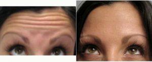 Doctor George Solomon, MD, Palm Harbor Physician - 24 Year Old Woman Treated With Botox For Forehead Lines