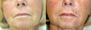 Doctor Harold J. Kaplan, MD, Los Angeles Facial Plastic Surgeon - Juvederm For Smile Lines And After Pictures