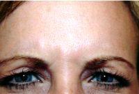 Doctor J. Jason Wendel, MD, FACS, Nashville Plastic Surgeon - 43 Year Old Female Treated For Forehead Wrinkles Botox Cosmetic