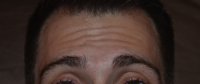 Doctor Jason Emer, MD, Los Angeles Dermatologic Surgeon - 30 Year Old Male Treated For Forehead Lines