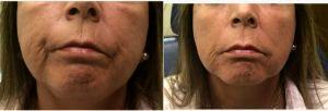 Doctor Jason M. Petrungaro, MD, FACS, Munster Plastic Surgeon - 67 Year Old Woman Treated With Restylane Injected Into Marionette Lines