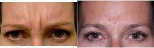 Doctor Jean Keamy, MD, Westborough Ophthalmologist - 36 Year Old Woman Treated With Botox