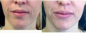 Doctor Jeff Birchall, MD, Carlsbad Physician - 31 Year Old Woman Treated With Juvederm