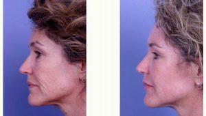 Doctor Jeffrey R. Raval, MD, FACS, MBA, Denver Facial Plastic Surgeon - 54 Year Old Woman Treated With Restylane, Botox And Microlaser Peel