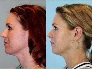 Doctor Jesse E. Smith, MD, FACS, Dallas Facial Plastic Surgeon - 40 Year Old Woman Treated With Botox