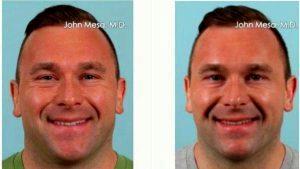 Doctor John Mesa, MD, New York Plastic Surgeon - 27 Year Old Man Treated With Botox For Crow's Feet Wrinkles
