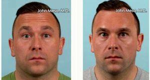 Doctor John Mesa, MD, New York Plastic Surgeon - 31 Year Old Man Treated With Botox For Forehead Lines